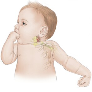 Brakiyal Pleksus (Kol Sinir Ağı) Yaralanması ve&nbsp;Fizyoterapi